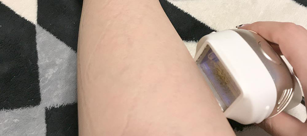 ケノンの照射面積について